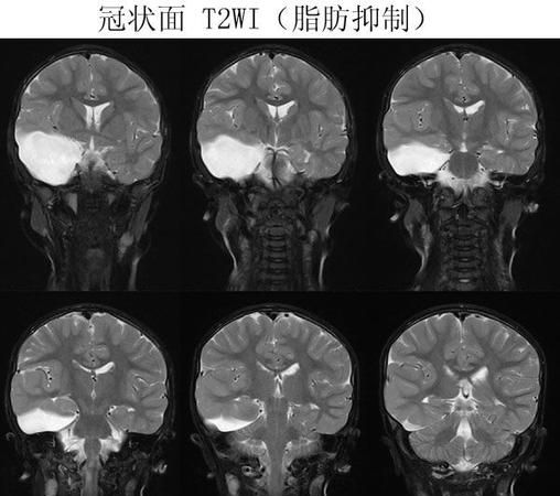 颞侧,颞侧注射方法及注意事项图1